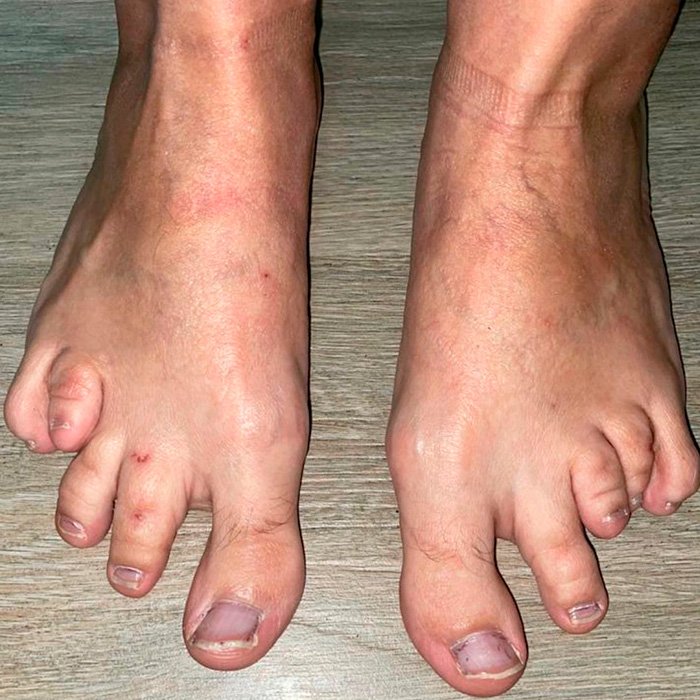 Pie Cenicienta Antes