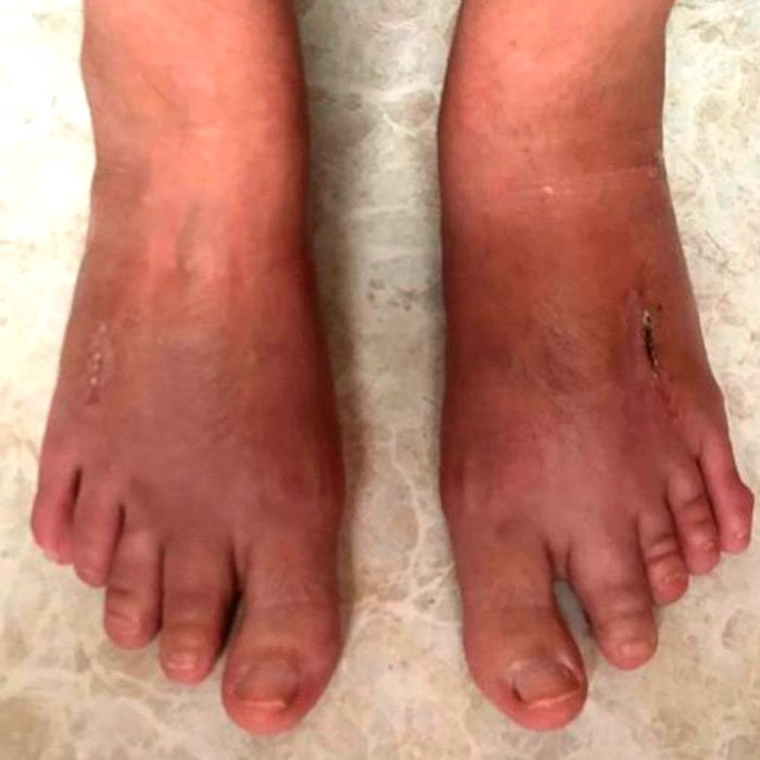 Pie Cenicienta Después